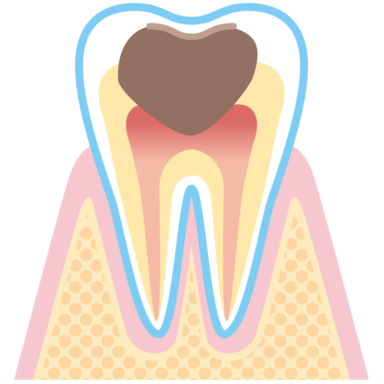 虫歯・後期（C3）のイメージ